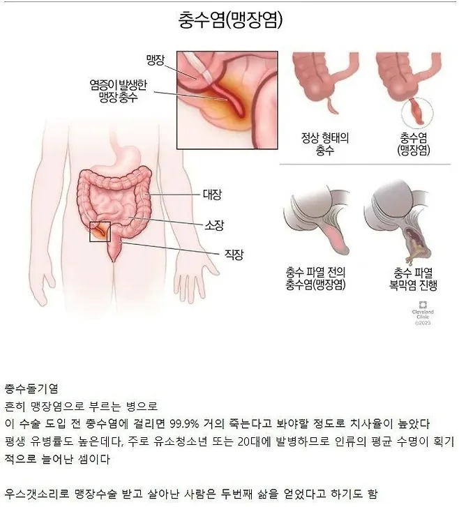 인류의 수명을 거의 2배로 늘려준 수술